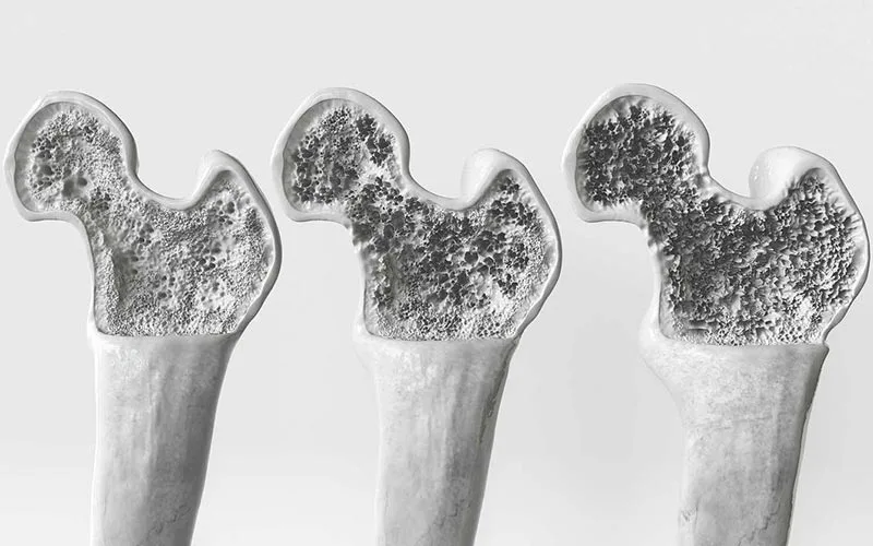 osteoporose uma doenca ossea silenciosa